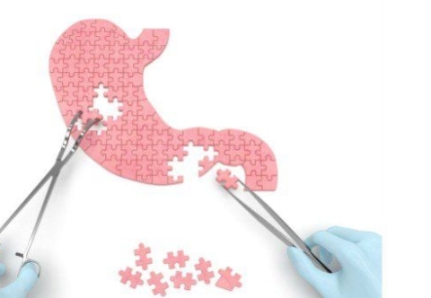 Ung thư dạ dày tái phát sau phẫu thuật triệt căn phải làm sao